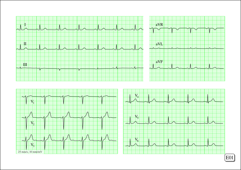 Creation of an ECG workbook with Scribus